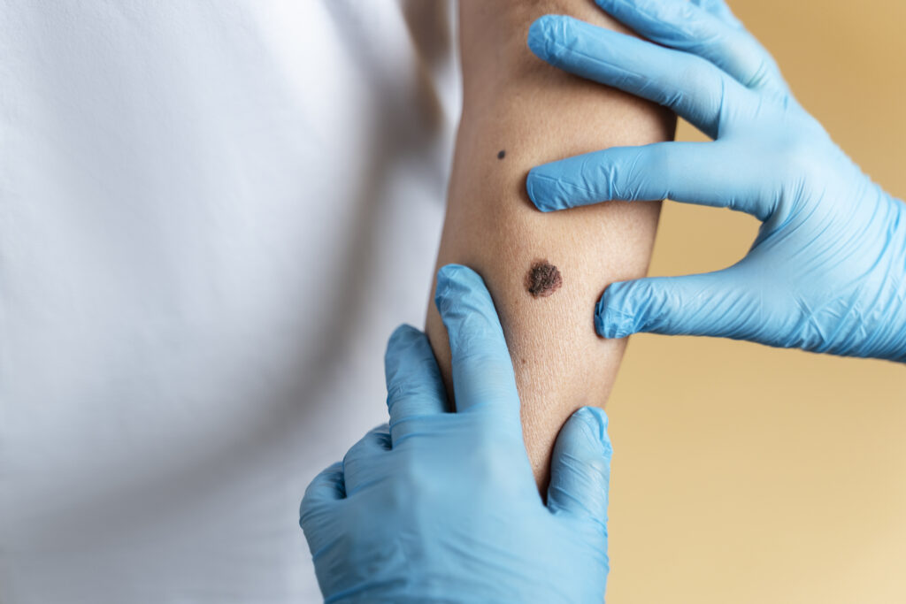 Du siehst den Unterarm eines Menschen mit einem groÃen Muttermal sowie zwei HÃ¤nde in blauen Gummihandschuhen